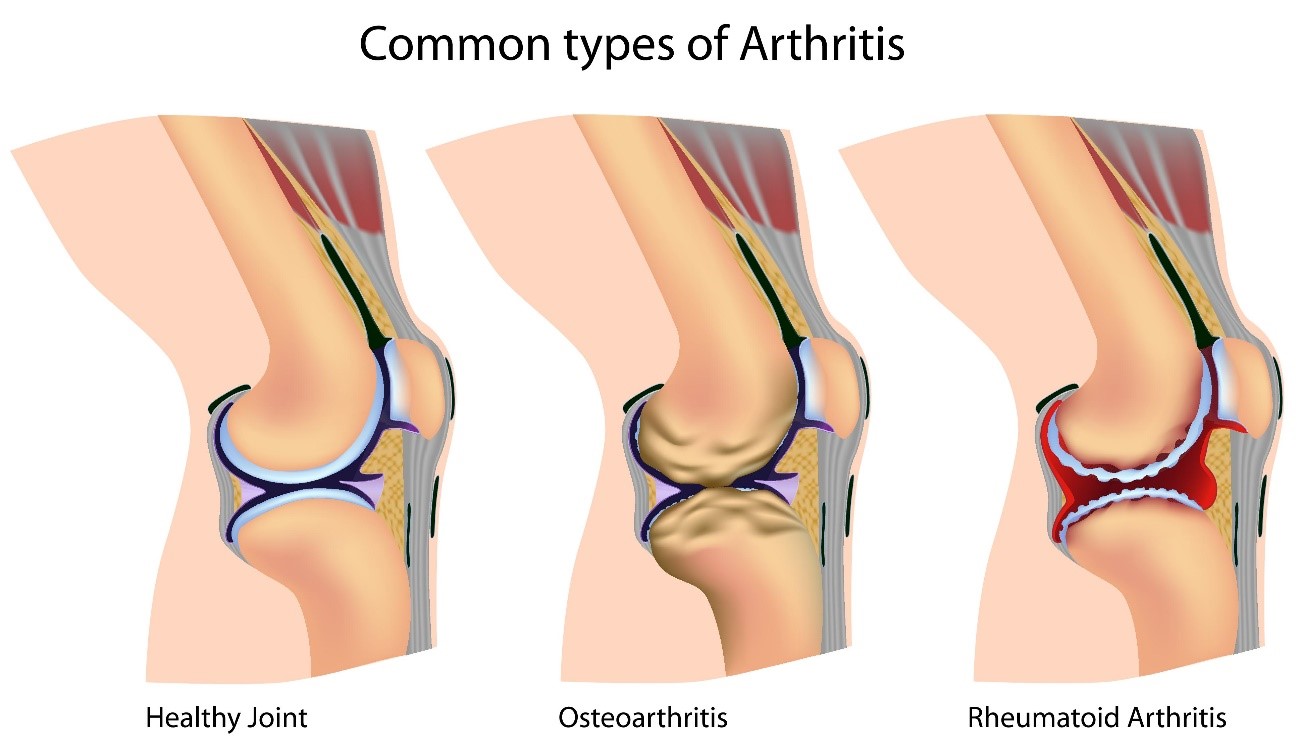 a láb deformációja térd artrózisával